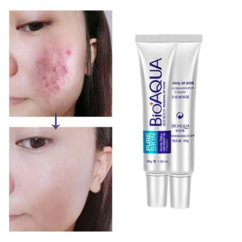 Premium Acne Scar Removal Cream - 30ml for All Skin Types - Hydrating Formula - Curerology