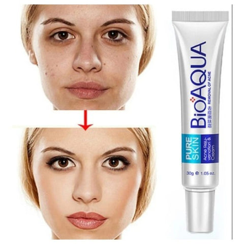 Premium Acne Scar Removal Cream - 30ml for All Skin Types - Hydrating Formula - Curerology